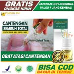 Obat Cantengan Yang Sudah Parah