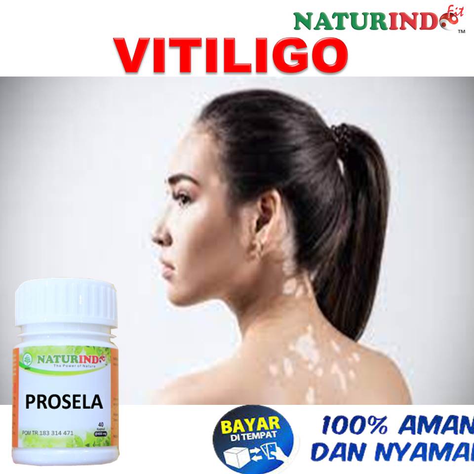 Obat Vitiligo Yang Sudah Terbukti