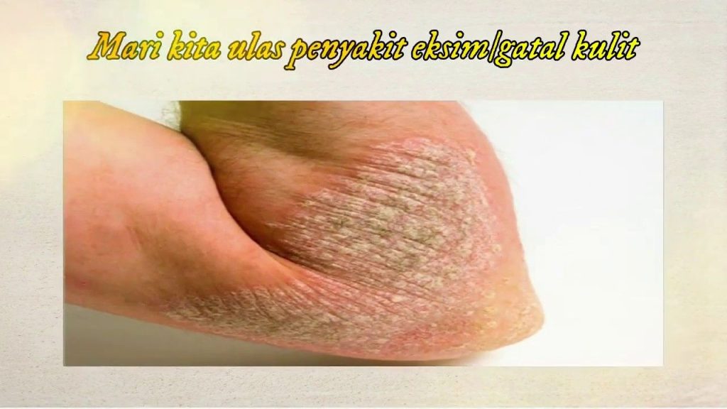 Cara Mengobati Kadas Cara Mengobati Kadas