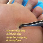 Obat Mata Ikan Di Telapak Kaki Obat Mata Ikan Di Telapak Kaki