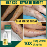 Obat Koreng Bernanah Tradisional