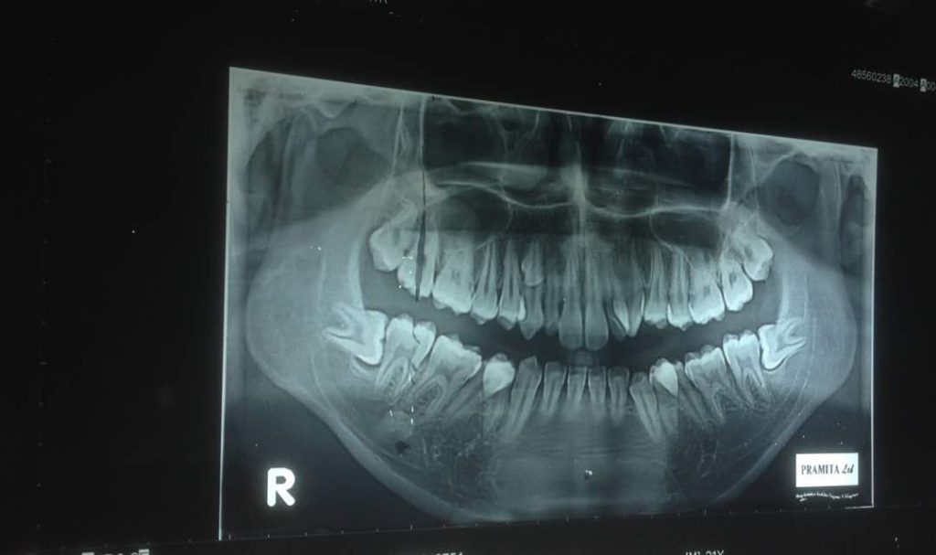 Operasi Gigi Bungsu Ditanggung Asuransi