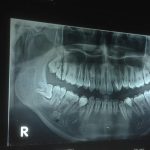 Operasi Gigi Bungsu Ditanggung Asuransi