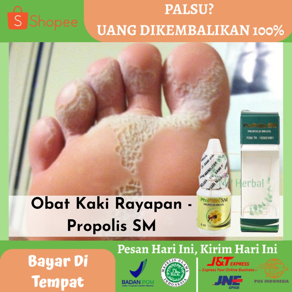 Obat Sakit Telapak Kaki