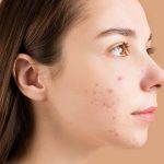 Pengobatan Jerawat