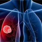Cara Mengobati Kanker Paru Paru