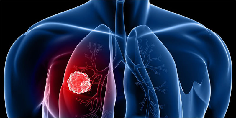 Cara Mengobati Kanker Paru Paru