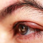 Cara Mengobati Bintitan Di Mata