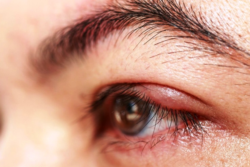 Cara Mengobati Bintitan Di Mata