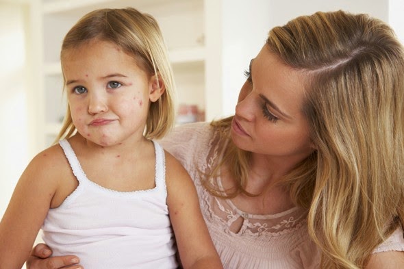 Cara Mengobati Cacar