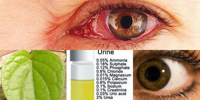 Cara Mengobati Mata Sakit