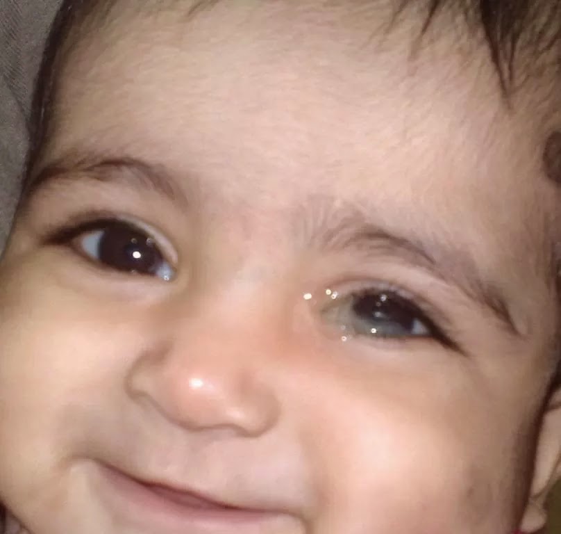 Cara Mengobati Sakit Mata Belekan