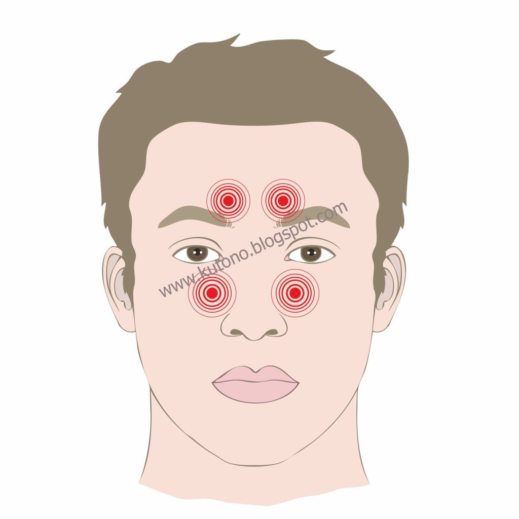 Mengobati Sinusitis Mengobati Sinusitis