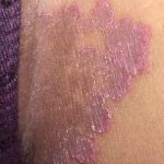 Cara Mengobati Jamur Di Selangkangan