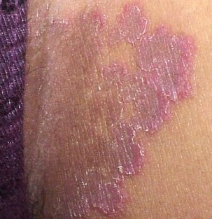 Cara Mengobati Jamur Di Selangkangan Cara Mengobati Jamur Di Selangkangan