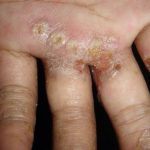 Pengobatan Scabies Pada Manusia Secara Tradisional Pengobatan Scabies Pada Manusia Secara Tradisional