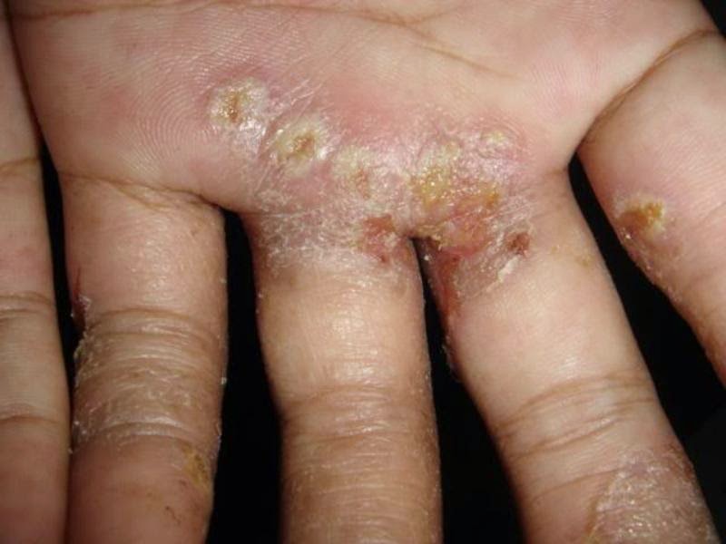 Pengobatan Scabies Pada Manusia Secara Tradisional Pengobatan Scabies Pada Manusia Secara Tradisional