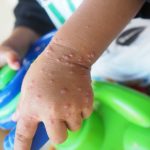 Pengobatan Flu Singapura