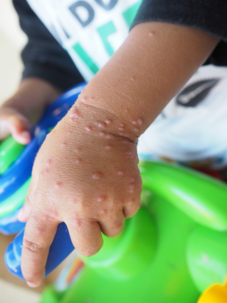 Pengobatan Flu Singapura