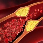 Obat Untuk Menurunkan Kolesterol