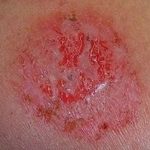 Cara Mengobati Gatal