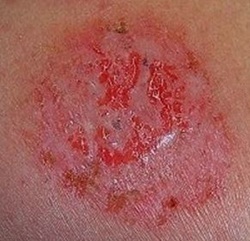 Cara Mengobati Gatal