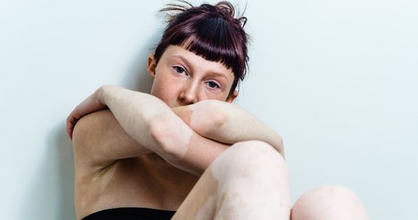 Obat Vitiligo Di Apotik