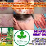 Cara Mengobati Alergi Kulit Bentol