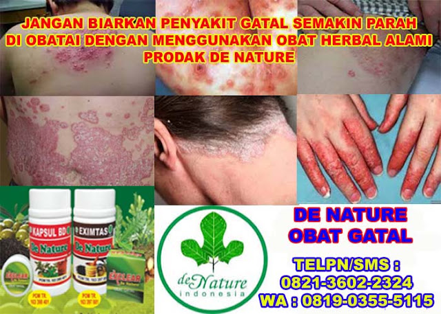 Cara Mengobati Alergi Kulit Bentol