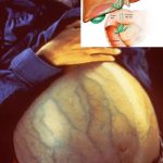 Obat Hepatitis A Obat Hepatitis A