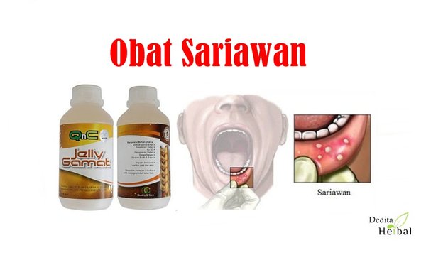 Obat Untuk Sariawan Di Lidah
