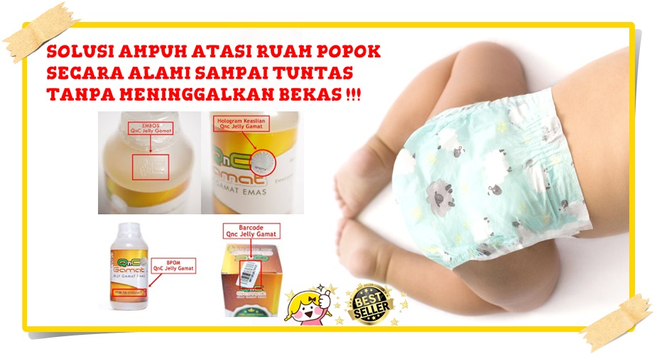 Cara Mengobati Ruam Popok Pada Bayi