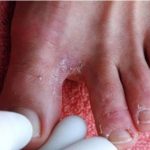 Cara Mengobati Kutu Air Di Kaki