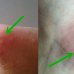 Luka Bernanah Obatnya Apa