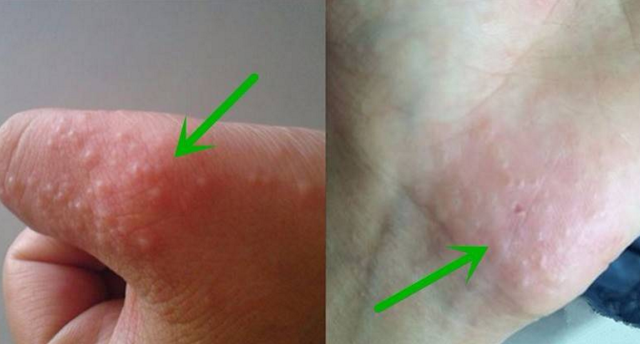 Luka Bernanah Obatnya Apa