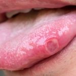 Obat Sariawan Di Lidah Paling Manjur