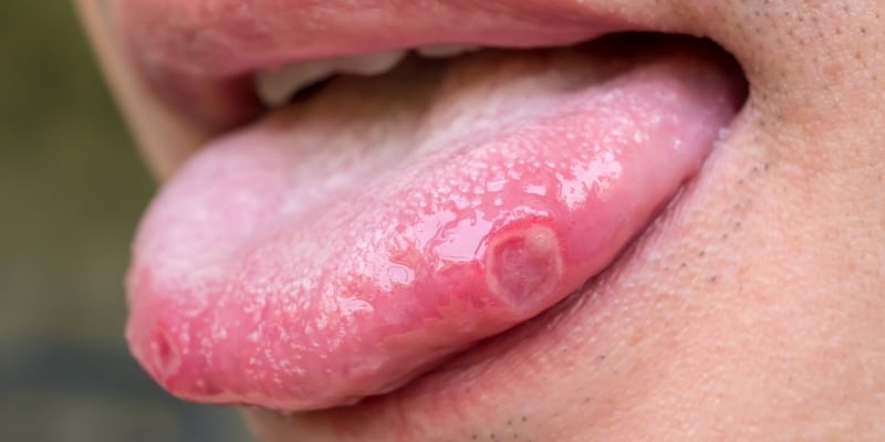 Obat Sariawan Di Lidah Paling Manjur Obat Sariawan Di Lidah Paling Manjur