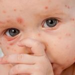 Cara Mengobati Cacar Air Pada Orang Dewasa