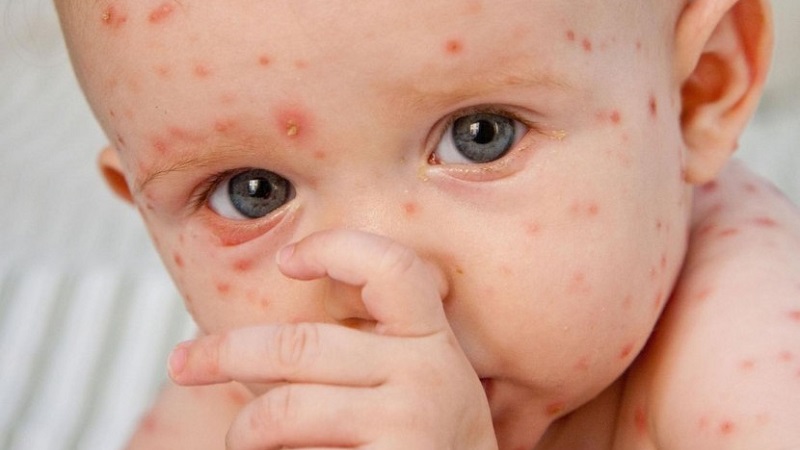 Cara Mengobati Cacar Air Pada Orang Dewasa