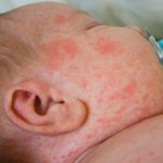 Cara Mengobati Campak Pada Orang Dewasa