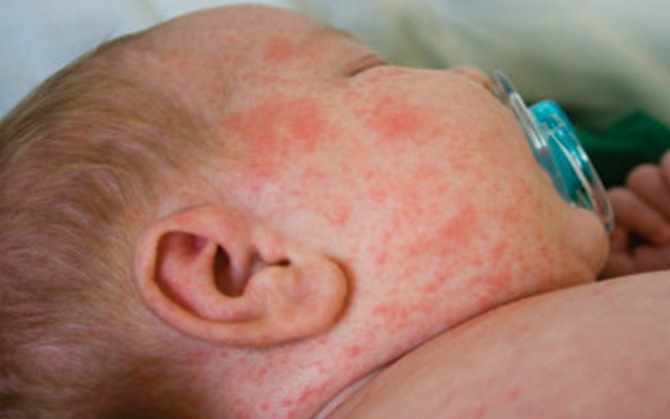 Cara Mengobati Campak Pada Orang Dewasa Cara Mengobati Campak Pada Orang Dewasa