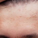 Obat Jerawat Bruntusan Di Apotik