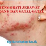 Cara Mengobati Gatal Yang Melingkar