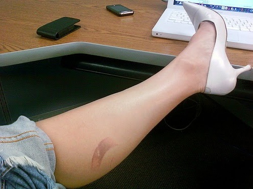 Cara Mengobati Luka Kena Knalpot