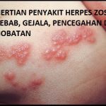 Pengobatan Herpes Pengobatan Herpes