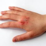 Mengobati Luka Bakar