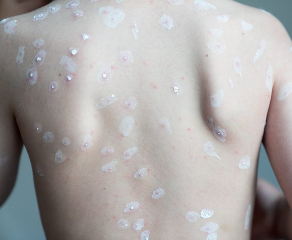 Obat Herbal Cacar Air