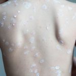 Obat Herbal Cacar Air