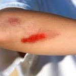 Obat Kaki Bengkak Karena Jatuh