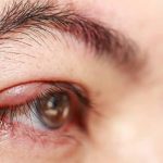 Mata Bintitan Obatnya Apa